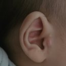 (주)하나로메디 | 다산 아이앤힐 성형외과 – 신생아 스킨텍(귀젖) 제거! 120일 아기 낮잠 수술 리얼 후기~!!(사진주의..!!)