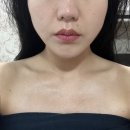브라이트스타 | 대학로피부관리 잘하는곳 부르힐에스테틱 본점 미백관리 브라이트스타 받은 후기