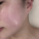 문라이트(Moon Light) | 청주 오송 피부관리 [ 문라이트뷰티 ] 알테온 안아픈 윤곽 리프팅 후기