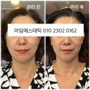 선릉역 윤곽관리 가격과 효과 솔직 후기(+아임에스테틱)