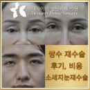 플로라성형외과의원 | 쌍수재수술 왜 할까?후기와 비용, 소세지눈재수술 기준 정리