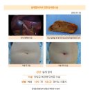 쓸개결석수술후기. 막상 수술을 받고 보니 빠른 수술 시간과 수술 후 잠시 통증이 있는가 싶더니 금세 안정이 되면서 두세 시간 후에는 걸으면서 몸이 편안... 이미지