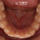 플러스치과기공소 | 덧니 2급 부정교합 인비절라인 발치 후기 분당 교정치과