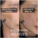 블루미의원 | 을지로입구역피부과 세르프리프팅 레이저300샷 즉각적인효과 내돈내산 후기