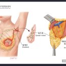 갱신형 유방절제후림프부종증후군 진단비보장 특별약관(유방절제후림프부종증후군의 정의 및 진단확정) 이미지