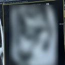 연세모아 병원 버스정류장 | 30대중반 자궁근종 다빈치로봇수술 연세사랑모아여성병원 후기 (3-4일차)