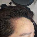 주식회사 지니소프트 | [서울] 강남헤어라인 저통증 자연스러운 양재 두피커버 &#34;에디뷰티&#34;