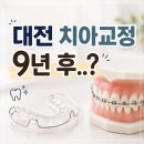 오부부치과의원 | 대전 교정치과 서울오라클치과 | 치아교정 유지기 떨어짐 재부착 후기