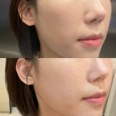 홍대 팔자주름 앞볼 필러 효과 후기 (전후)