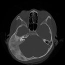 와우수술 하려고 Temporal bone CT검사한 영상입니다.. 이미지