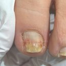 푸스케어 부산당감점 쿤스트뷰티 | 부산내성발톱, 푸스케어 부산당감점에 소문듣고 오신