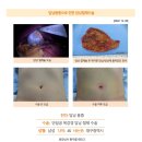 담낭용종수술후기. 10년 전 생긴 0.5cm 담낭용종, 5년 전 1.4cm로 커져서 절제수술을... 이미지