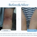 저지한의원 | 사이폴엔연질캡슐 부작용, 오래 먹어도 안전한가요? 아토피 사이폴엔 부작용·효능 총정리