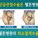 고관절 인공관절 재수술원인 1위 탈구!! 최소화관건은 근육힘줄보존 최소절개술입니다. 이미지