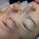 셀리핏 | 동탄모공관리 트라이엄 포어핏 솔직후기 (전후사진 비교) 셀리올리스킨랩 동탄점