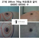 [남자유두축소수술] 27세 180cm 76kg 여유증과 같이 8X8X5 / 8X9X6 → 4X5X2 _1 이미지