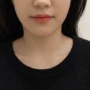 메이린의원 | 메이린의원 청주에서 BBL레이저 드뎌 받아본 후기(전후사진O)