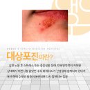 대구S한방병원 네이버블로그