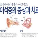 이석증 수술 자가치료법 주요 증상 예방 이미지