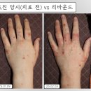손한의원 | 병원 다녀도 낫지 않던 일하다 생긴 한포진과 손 습진! 한약, 침, 약침 치료로 한의원에서 해결했습니다