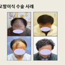 더모헤어플란트 미지예피부과