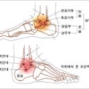 발목인대 파열(염좌,접질렀을 때)되었을 때 치료법 외 기타등등 이미지