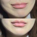 [서울]가로확장입술필러/입술필러후기/내돈내산/솔직후기/붓기