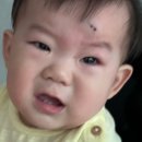 송도효자병원 | 아기 이마 찢어짐 연수구 송도 병원 방문 후기와 경과