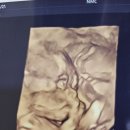 국립중앙의료원 | 서울 중구 산부인과] 둘째 우동이 병원 정착기! 국립중앙의료원 산부인과