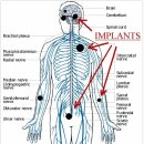 신체 임플란트(나노봇 포함)의 영향 이미지