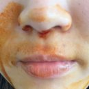 웅천치과의원 | 교정일기/인비절라인 2년 후기