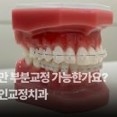 (주)이미인 | 앞니교정,부분교정 비용 기간 총 정리, 실패하는 케이스 특징 3가지