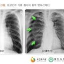 기흉 초기증상 원인 폐 기흉 치료 예방방법 이미지