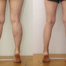 아름다운 여성의원 | 종아리 다이어트 + 종아리살빼기 SAGE power >>> 쫑알주사 비용 - 세이지의원 리포트