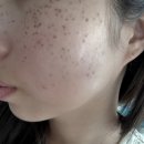 서울이내과의원 | 압구정 루나의원 ｜ 루비레이저 내돈내산 시술 과정 및 1년 솔직 후기