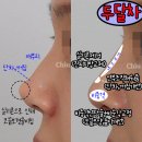 진주성형외과의원 | 무보형물코재수술, 코끝 피부가 얇아지면 생기는 변화