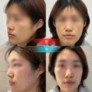 서울 강남 신논현 ) 와우성형외과의원 볼 + 앞광대 필러 후기