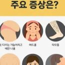 호르몬 이상 쿠싱증후군 쿠싱병 원인 증상 치료 이미지
