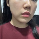 V-3 | 강남역 성형외과 v라인 윤곽주사 3회차 후기