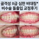 진수선 | 심한 비대칭의 II급 부정교합, 비수술 발치교정 치료후기