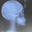 지장1천 | 대학병원 설측교정 돌출입 교정 후기