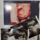 늘기쁜어린이집 | 두번째 임신 그리고 출산(feat. 연년생 당첨, 청주 미즈맘 산부인과)