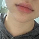 111의원 | 입술필러 1cc 신사 하이미의원 솔직한 후기