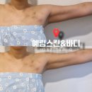 예비 신부의 팔뚝관리 동대구역 다이어트 예림스킨앤바디 웨이브온 후기