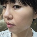 한이원 | 수원편평사마귀 제거 매끄러워진 피부변화 기록 후기