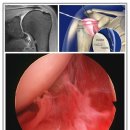어깨회전근개파열!! 어깨충돌증후군!! 진단과치료는 오십견치료방법 이미지