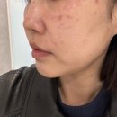 남양주 피부과 노블린 레이저 한달 후기: 홍조와 색소 개선 효과 (내돈내산)
