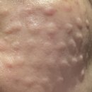 지성치과의원 | 속건성 피부 💉리쥬란 힐러(PDRN 주사)당일 후기 + 통증 극상