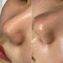 건대스킨플래닝 고에이바뷰티 꿀세라링 받은 리얼 후기 ! (블랙헤드, 피지제거에 탁월)