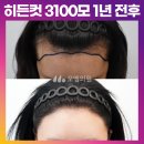 [30대 여자 넓은이마 헤어라인교정 머리심기] 비절개 히든컷 모발이식 3100모 1년 전후 (모엠의원/헤어라인/전지훈원장) 이미지